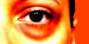 Young People Are Removing Their Eye Bags With Surgery: How, Why, Costs