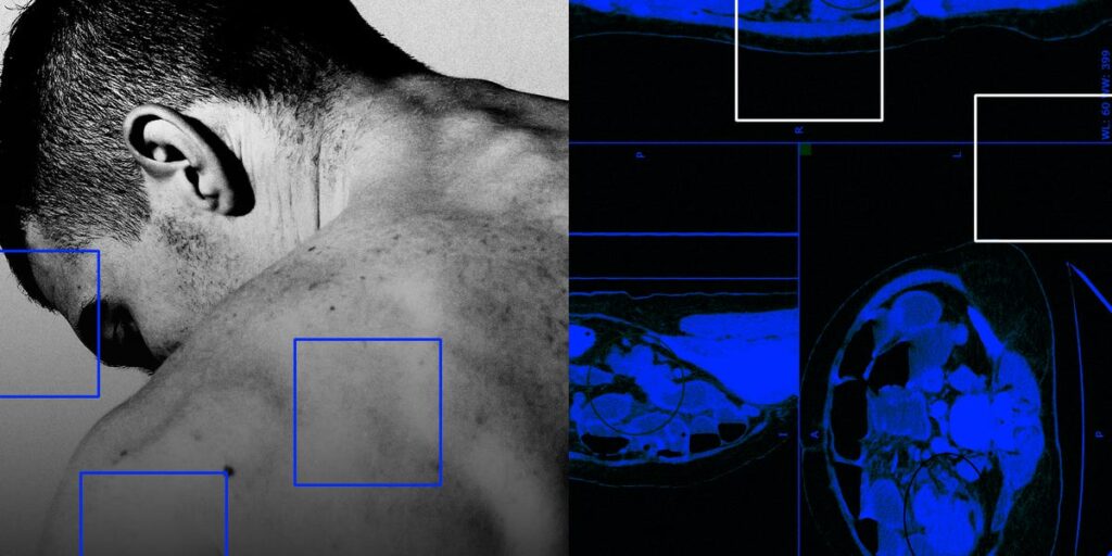 Why Are so Many Young People Getting Colon Cancer? the Answer Could Trace Back to Infancy