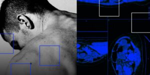 Why Are so Many Young People Getting Colon Cancer? the Answer Could Trace Back to Infancy Why Are so Many Young People Getting Colon Cancer? the Answer Could Trace Back to Infancy