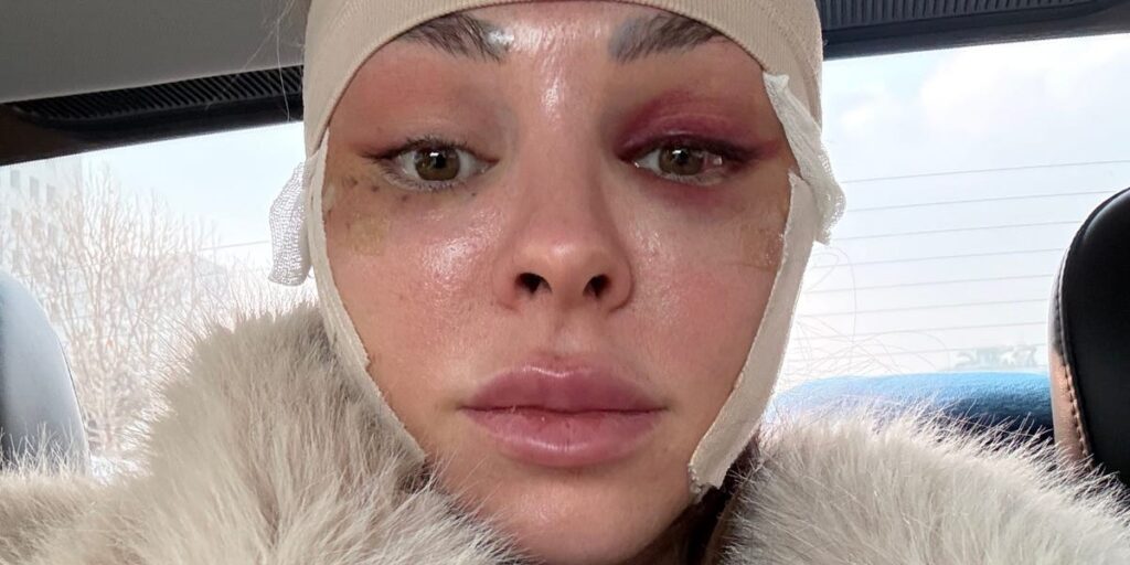 I traveled from the US to South Korea to get a facelift at 34. It boosted my confidence.