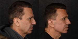 C-suite execs are paying surgeons big money to look fresh-faced, approachable, and less irritable