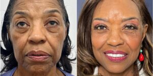 I paid 2,000 for a facelift at 71. I wish I could have done it a decade ago, but I couldn’t afford it.