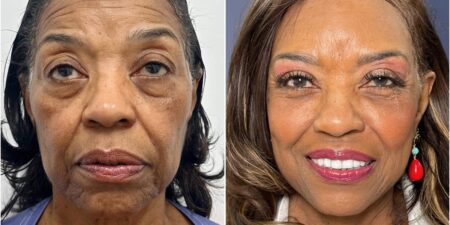 I paid 2,000 for a facelift at 71. I wish I could have done it a decade ago, but I couldn’t afford it.