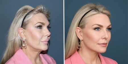 AI face is taking over — and driving plastic surgeons crazy