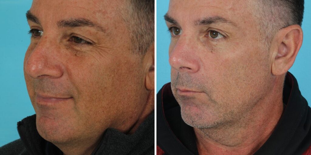 I’m a retired firefighter. I spent ,000 on plastic surgery in my 50s, and I’m not ashamed. I’m a retired firefighter. I spent ,000 on plastic surgery in my 50s, and I’m not ashamed.