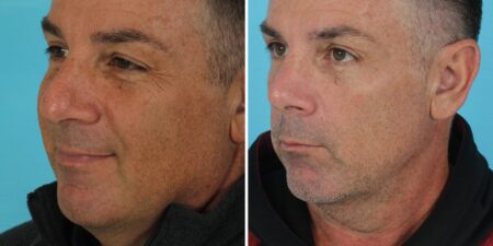 I’m a retired firefighter. I spent ,000 on plastic surgery in my 50s, and I’m not ashamed.